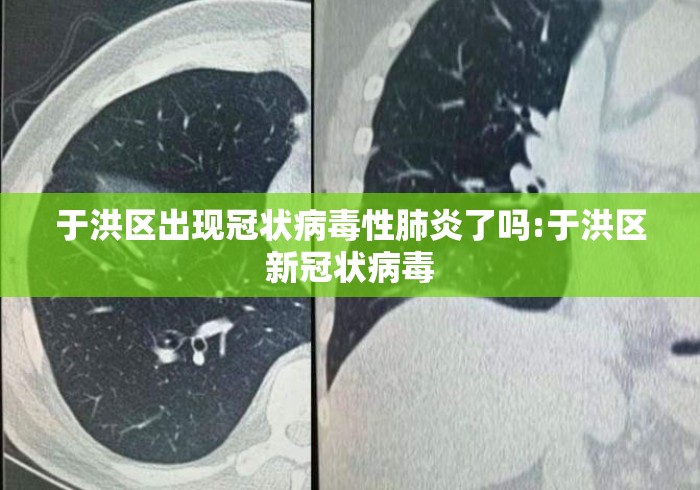 于洪区出现冠状病毒性肺炎了吗:于洪区新冠状病毒