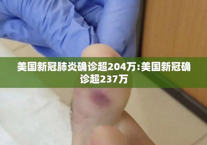 美国新冠肺炎确诊超204万:美国新冠确诊超237万